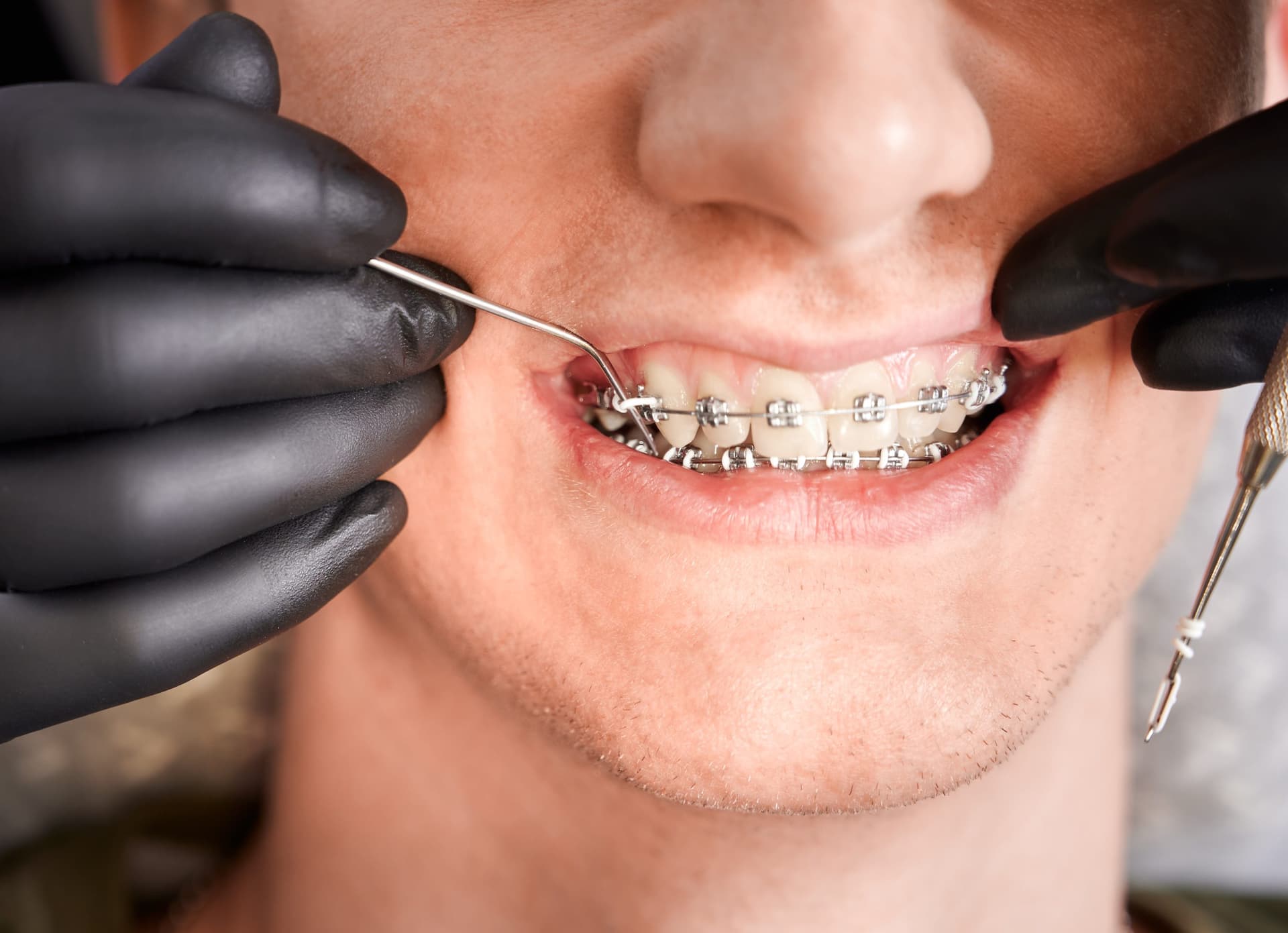 Transparente Zahnschiene: Die Vorteile von Invisalign für Ihre Zahnstellungskorrektur
